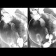 Crohn's disease of ileum: X-ray - Plain radiograph